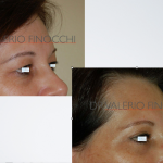 Blefaroplastica - pre e post intervento