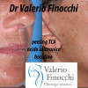 ringiovanimento viso, rughe , codice a barre